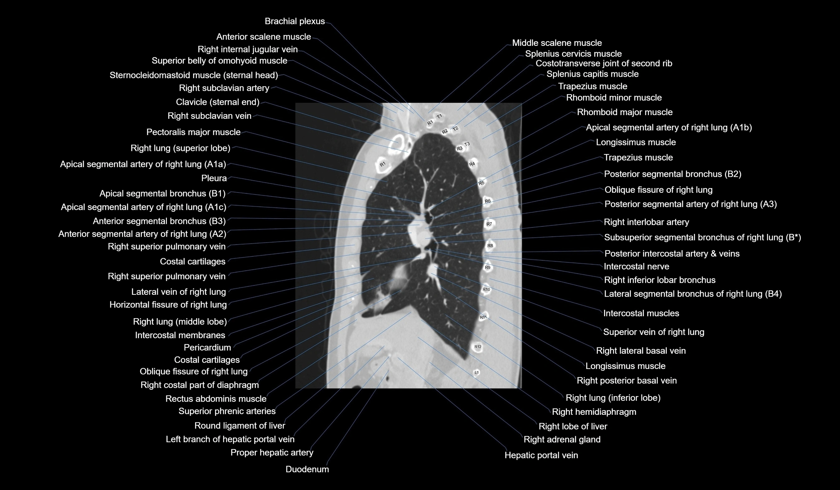 CT chest (thorax) lung window labelled sagittal cross sectional anatomy radiology image-00060.webp